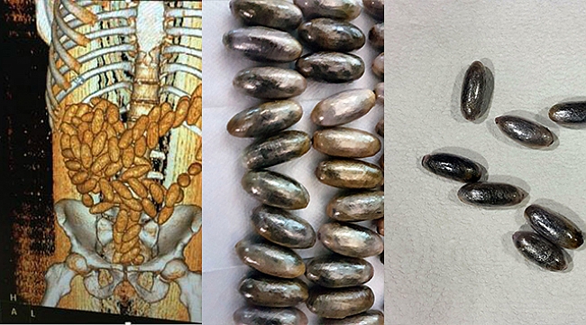 Midesinden 102 kapsül esrar çıktı