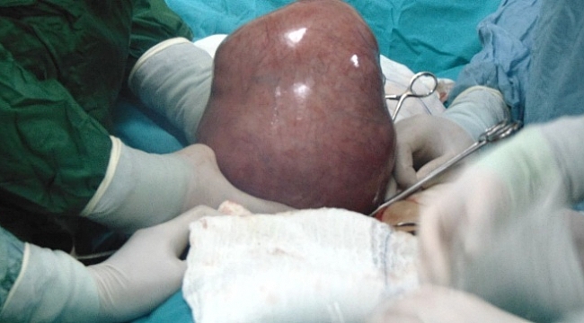 Karın ağrısı şikayetiyle gitti, rahminden 5 kilo ur çıktı