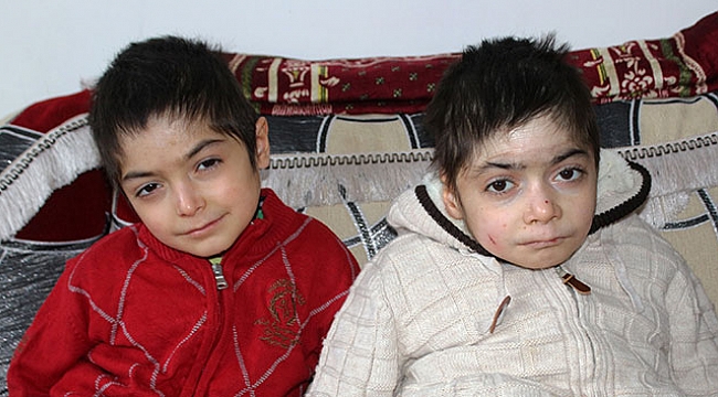 Kelebek hastası kardeşlerin dramı yürek burkuyor