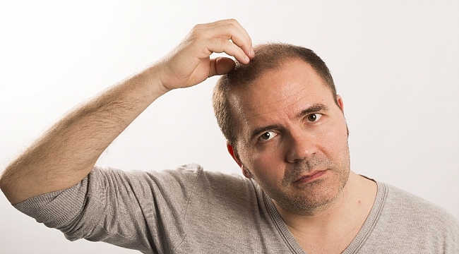 Uzmanlara göre saç ekiminde doğal görünüm önemli