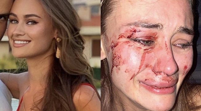 Ünlü model Çeşme'de darbedildi!