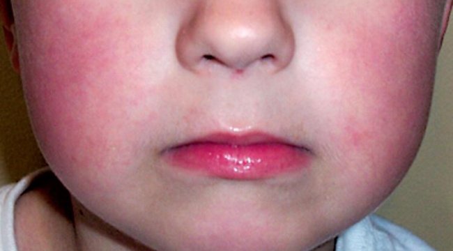 Çocuğunuz kırmızı yanaklı ise bu belirtilere dikkat