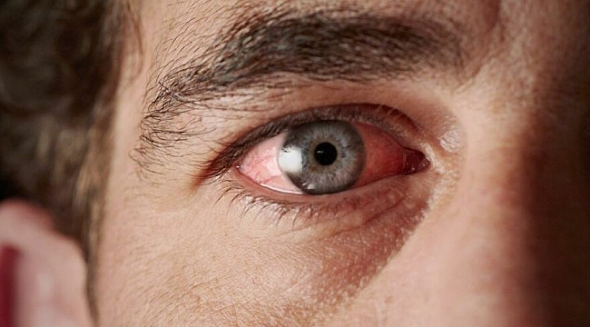 Omicron varyantının iki yeni “garip” semptomu ortaya çıktı