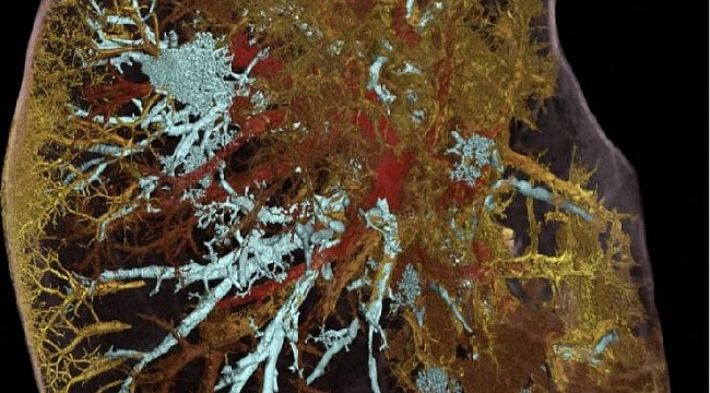 Covid-19’dan ölen bir kişinin akciğerlerini görüntülediler