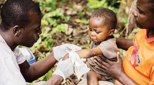 12 ülkede 92 vaka... Dünyada yeni korku: Maymun çiçeği