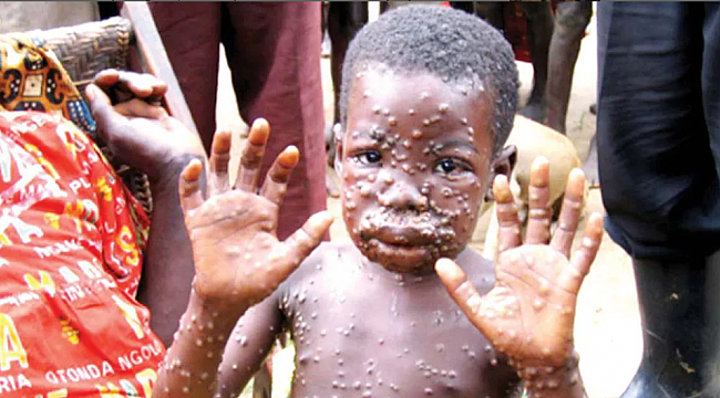 Uzmanlardan 'maymun çiçeği' uyarısı