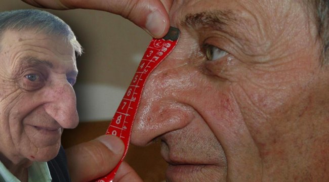 Dünyanın en uzun burunlu insanı Artvinli Mehmet Özyürek kalbine yenik düştü