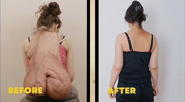 20 kiloluk tümörden sonunda kurtuldu!