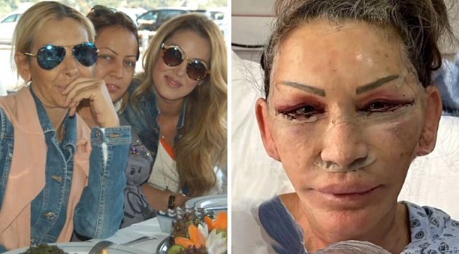 Petek Dinçöz&#039;ün annesi gerdirme ameliyatı oldu! Yeni hali şaşırttı