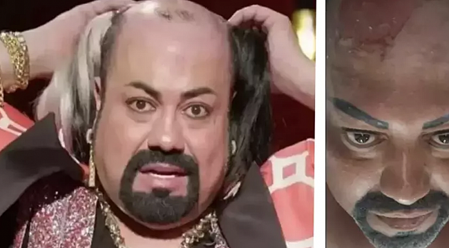 Protez saçı, başına bela oldu! Kobra Murat enfeksiyon kaptı