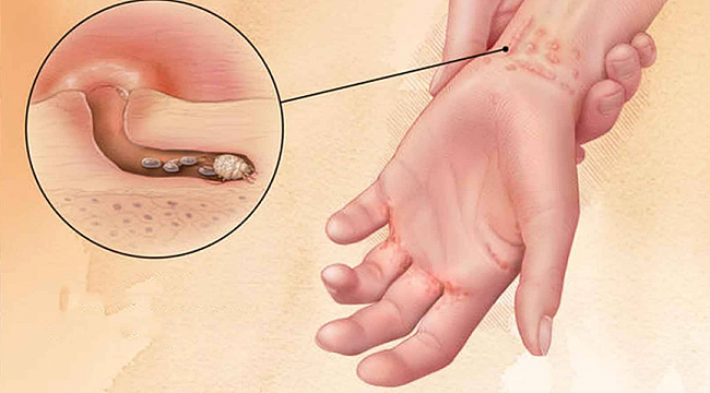 Uzmanı vakalara karşı uyardı; "Kollarda, ellerde, dirseklerde ve karın bölgenizde kaşıntı ve kızarıklık varsa uyuz olmuş olabilirsiniz." dedi.