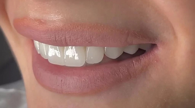 Gülüş Tasarımı Nedir? Kimler İçin Uygundur?