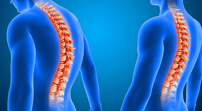 Skolyoz Tedavisinde Erken Tanı ve Tedavi Önemli...