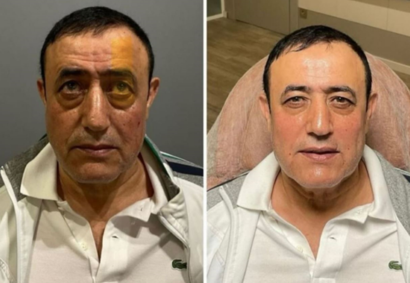 Mahmut Tuncer estetik yaptırdı! Sosyal medyada yapılan yorumlar efsane