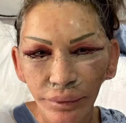 Petek Dinçöz'ün annesi gerdirme ameliyatı oldu! Yeni hali şaşırttı