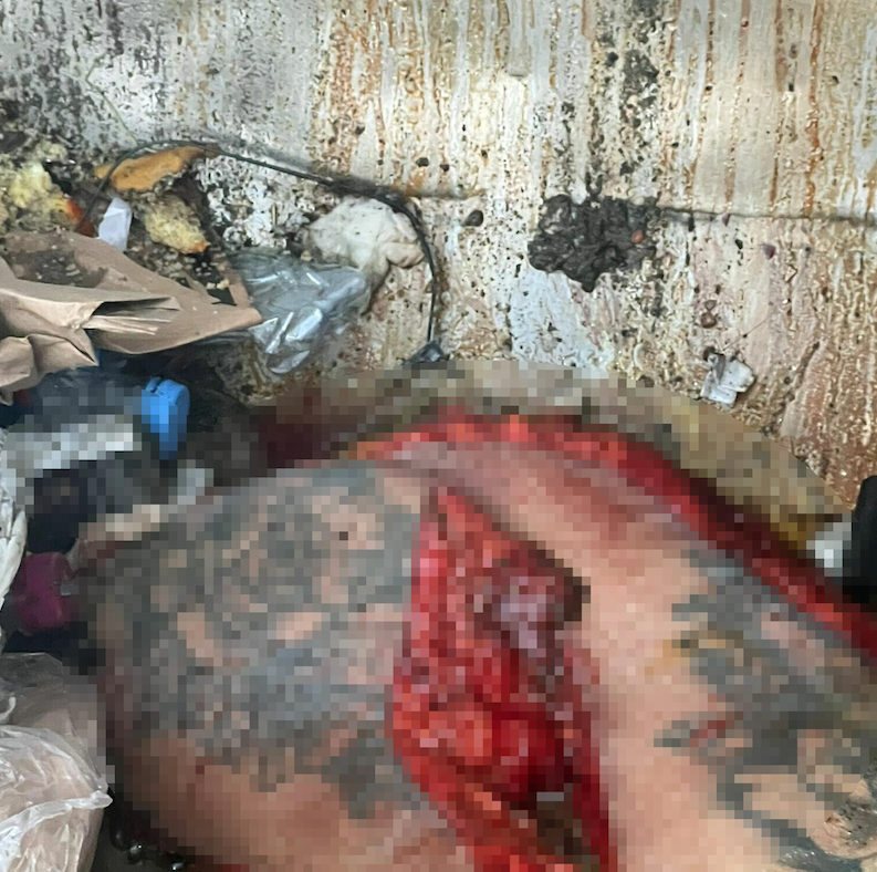 Sokakta bulunan yağ ve deri parçaları, 'merdiven altı' karın germe ameliyatında çıkarılmış