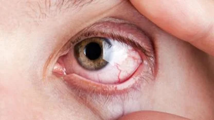 Göz Kuruluğuna Karşı Damla Tedavisi